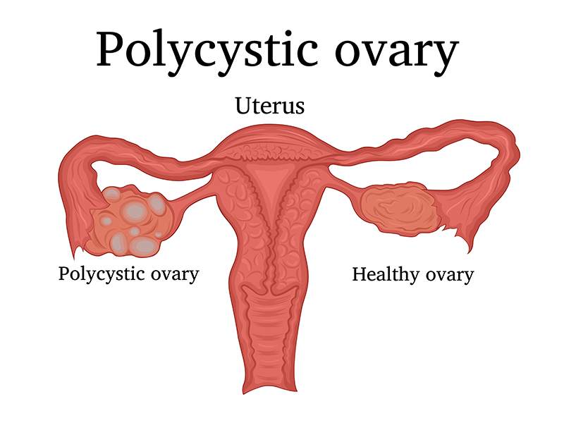 La sindrome dell’ovaio policistico: cos’è e quali sono le cause