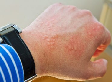 Dermatite da contatto: le cause più comuni