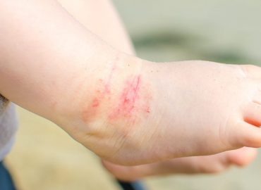 Quali sono i rimedi più efficaci per la dermatite atopica?