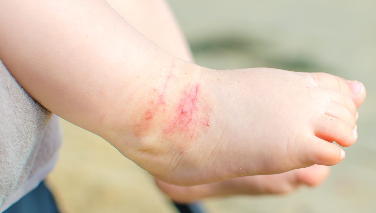 Quali sono i rimedi più efficaci per la dermatite atopica?