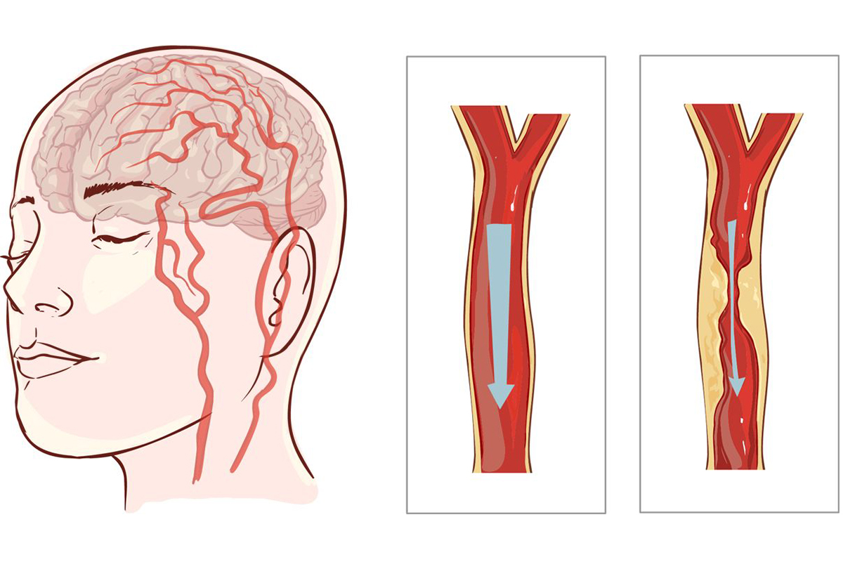 I consigli del cardiologo per prevenire un ictus cerebrale