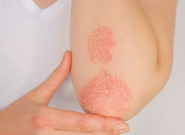 Psoriasi: quando consultare un dermatologo