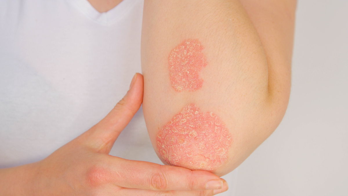 Psoriasi: quando consultare un dermatologo