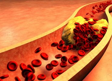 Come contrastare il colesterolo alto? I consigli dell'esperto