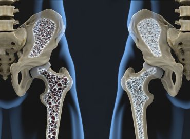 Tutto quello che devi sapere sull'osteoporosi
