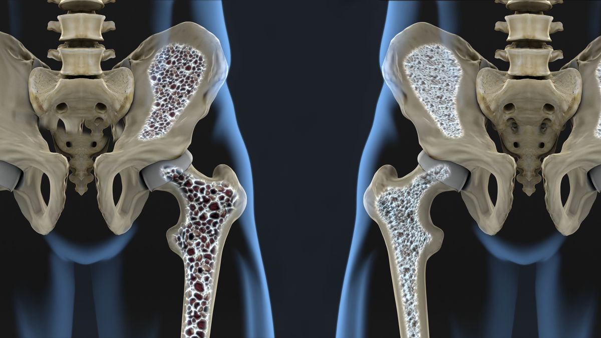 Tutto quello che devi sapere sull’osteoporosi