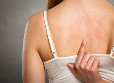 Le cause dell'orticaria e come si tratta