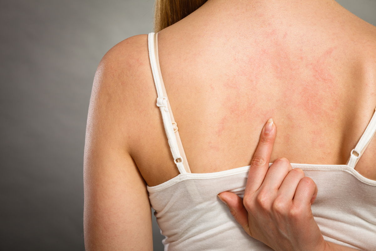 Le cause dell’orticaria e come si tratta