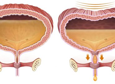 Ritenzione urinaria: cos'è e quando si verifica