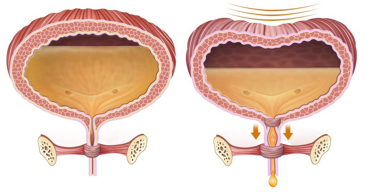 Ritenzione urinaria: cos’è e quando si verifica