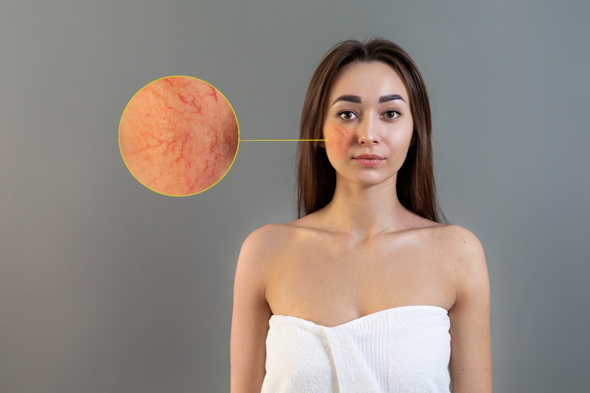 Malattie della pelle: cos’è la rosacea?