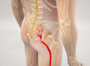 Lombosciatalgia: cos'è e come si manifesta