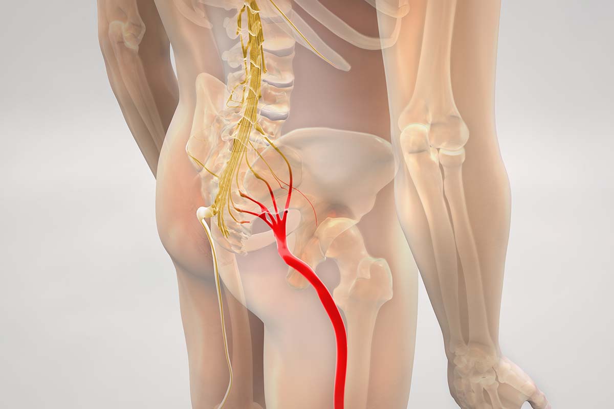 Lombosciatalgia: cos’è e come si manifesta