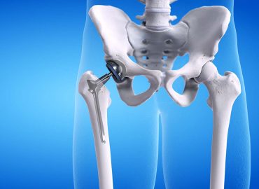 Protesi d'anca: quando è necessario l'intervento?