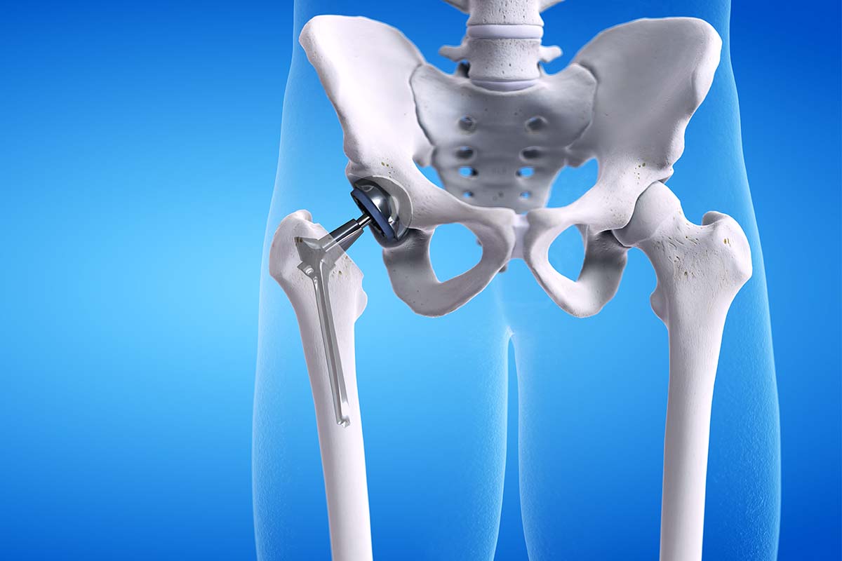 Protesi d’anca: quando è necessario l’intervento?
