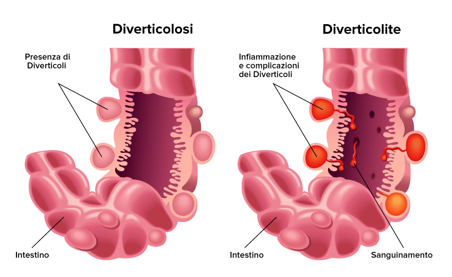 diverticolosi diverticolite