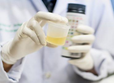 Leucociti nelle urine: che significa?