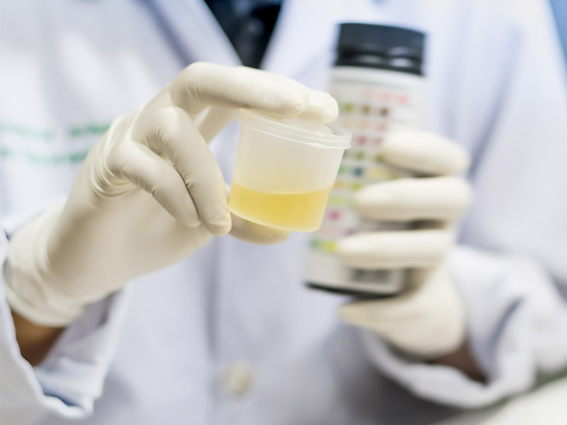 Leucociti nelle urine: che significa?