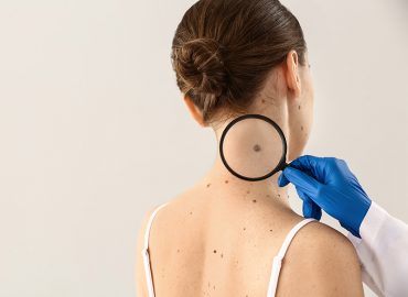 Melanoma: tipologie, sintomi, prevenzione