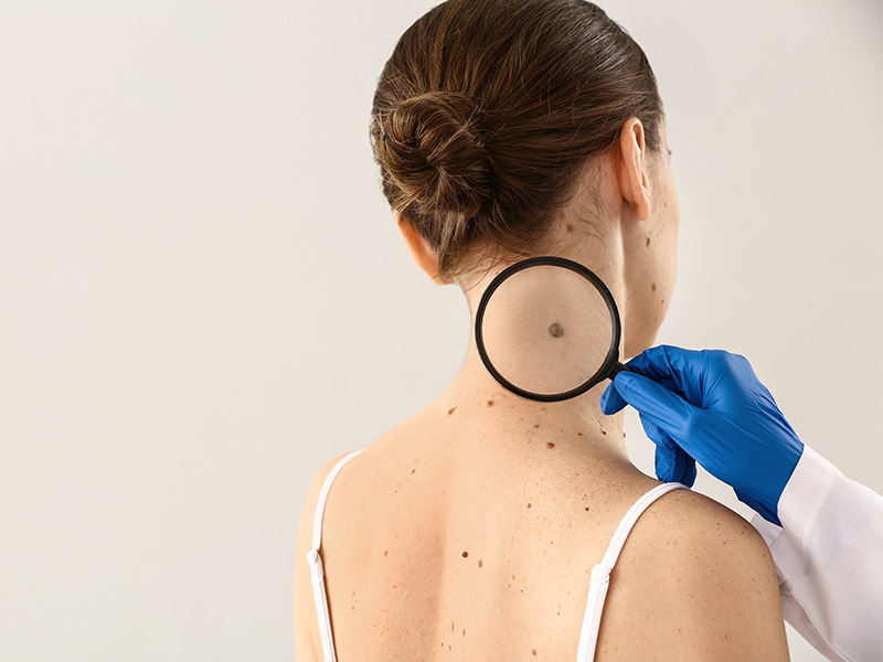 Melanoma: tipologie, sintomi, prevenzione