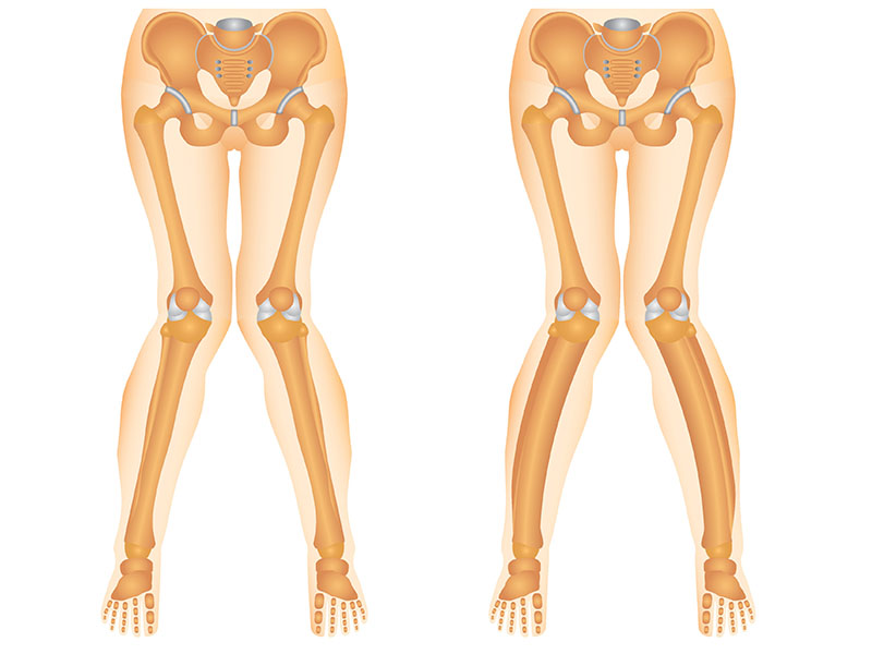 Ginocchio Valgo: cosa fare in caso di “gambe a X”?