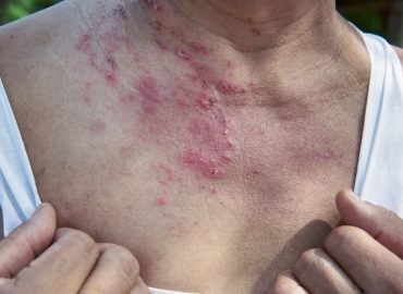 Herpes Zoster o Fuoco di Sant'Antonio: ecco cos'è