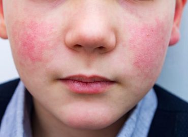 Orticaria da freddo: ne hai mai sentito parlare?