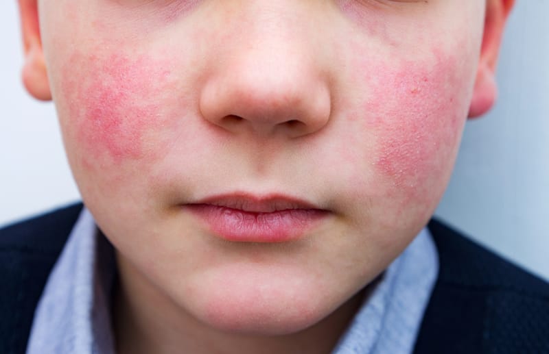 Orticaria da freddo: ne hai mai sentito parlare?