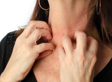Dermatite da sudore: alcuni consigli utili