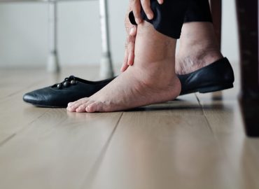 Estate e gambe gonfie: i consigli dell'angiologo