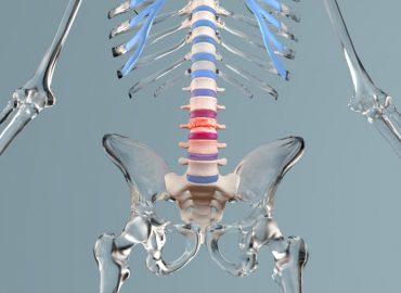 Vertebroplastica e Cifoplastica: trattamenti delle fratture vertebrali