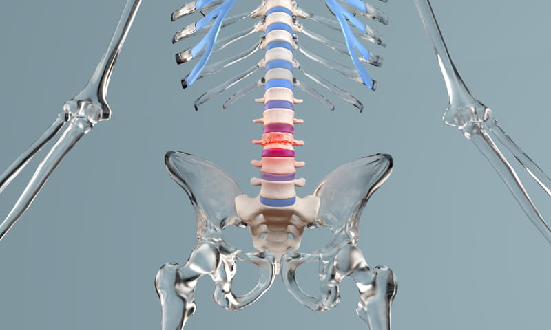 Vertebroplastica e Cifoplastica: trattamenti delle fratture vertebrali