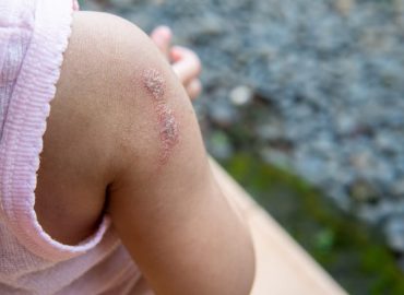 Impetigine nei bambini: cos'è e come riconoscerla