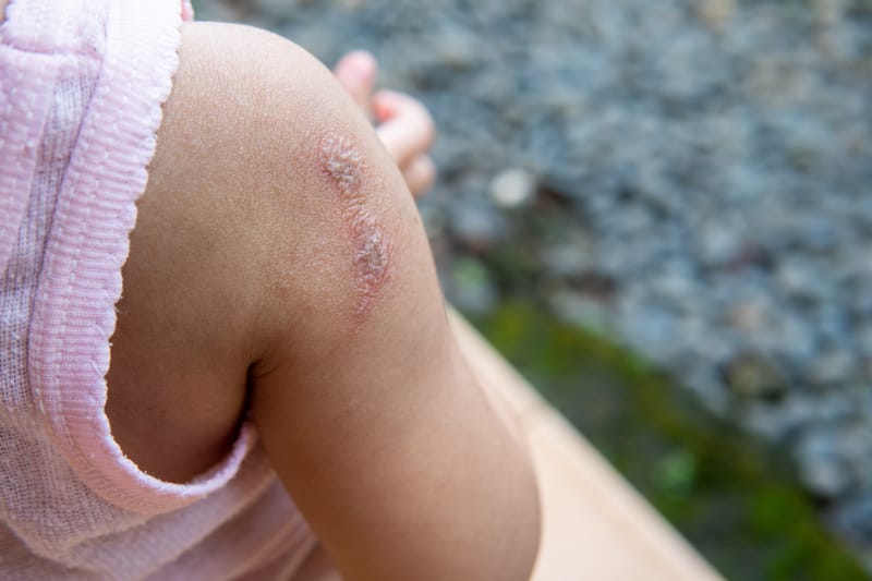 Impetigine nei bambini: cos’è e come riconoscerla