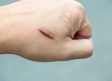 Cheloidi: cosa sono, sintomi, cause e trattamenti