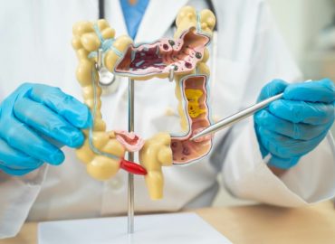 Rettocolite ulcerosa: sintomi, cause e trattamenti