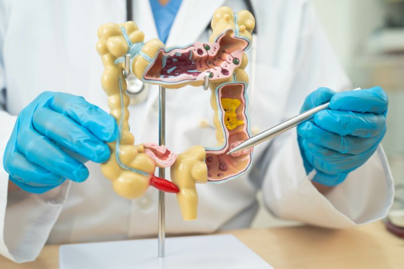 Rettocolite ulcerosa: sintomi, cause e trattamenti