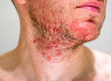 Follicolite: cos’è, come riconoscerla e curarla in modo efficace