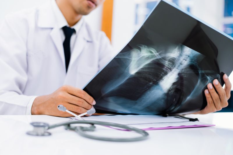 Addensamento polmonare: cause, sintomi e diagnosi