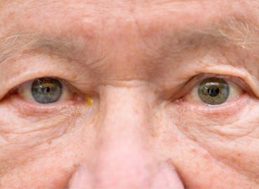 Anisocoria: perché le pupille hanno dimensioni diverse e quando preoccuparsi