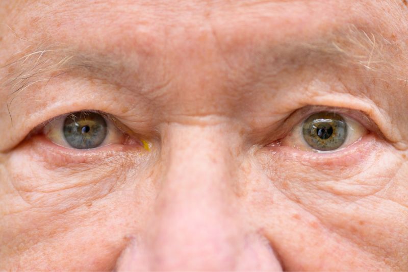 Anisocoria: perché le pupille hanno dimensioni diverse e quando preoccuparsi