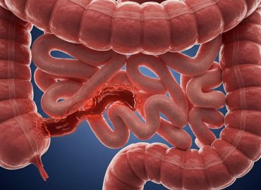 Perforazione intestinale: perché è un’emergenza e cosa fare in caso di sospetto