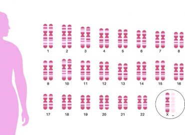 Sindrome di Turner: sintomi, diagnosi e gestione endocrinologica nelle diverse fasi della vita