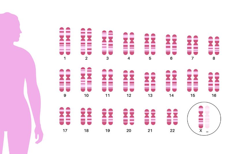 Sindrome di Turner: sintomi, diagnosi e gestione endocrinologica nelle diverse fasi della vita