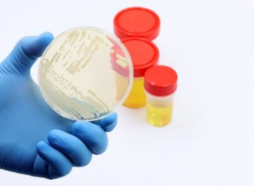 Batteriuria: cosa significa trovare batteri nelle urine e quando preoccuparsi