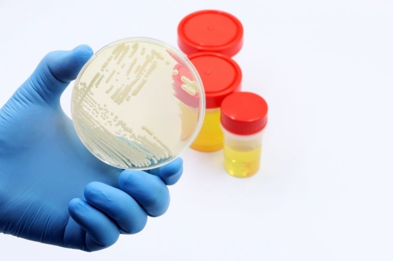 Batteriuria: cosa significa trovare batteri nelle urine e quando preoccuparsi