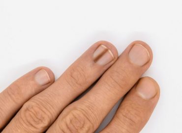 Onicopapilloma: cos’è, come riconoscerlo e quando intervenire