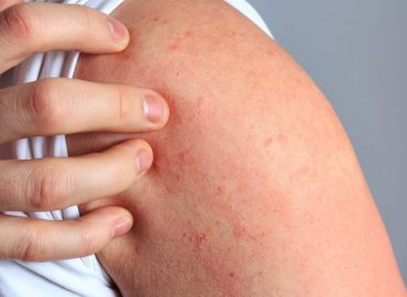Pitiriasi rosea di Gilbert: come riconoscere questa eruzione cutanea