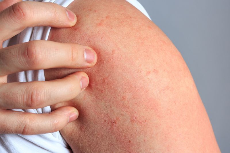 Pitiriasi rosea di Gilbert: come riconoscere questa eruzione cutanea