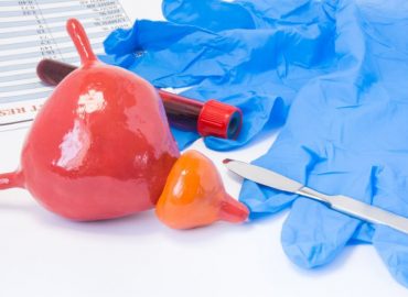 Diverticolo della vescica: cause, sintomi e possibili trattamenti